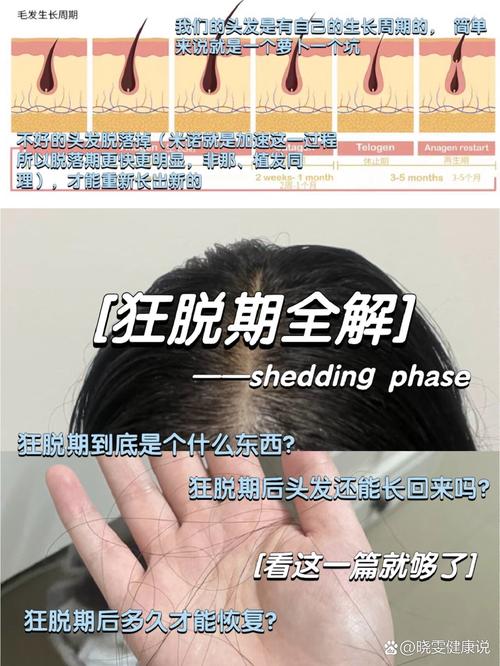2%米诺地尔有狂脱期吗、米诺地尔出现狂脱期的概率